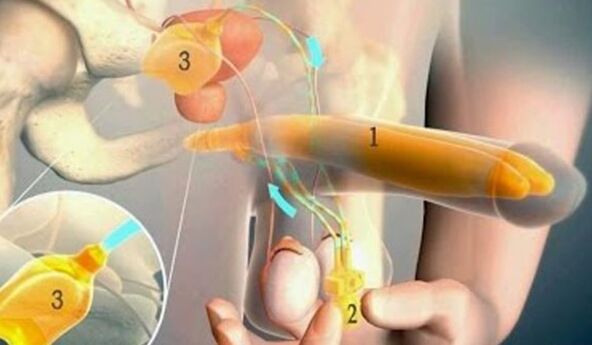 Falloprosthesis yang membesarkan organ genital lelaki